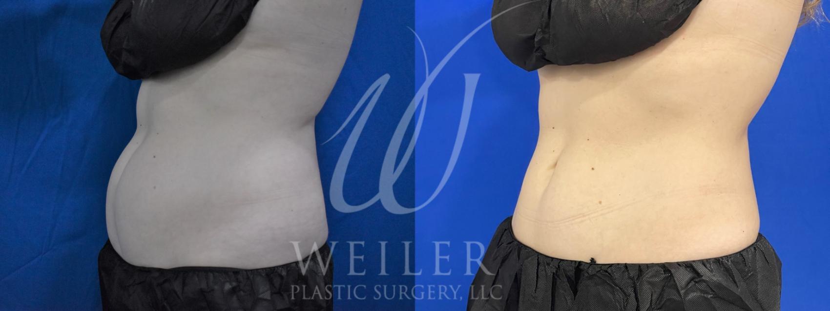 Before & After CoolSculpting Case 926 Left Oblique View in Baton Rouge, Louisiana