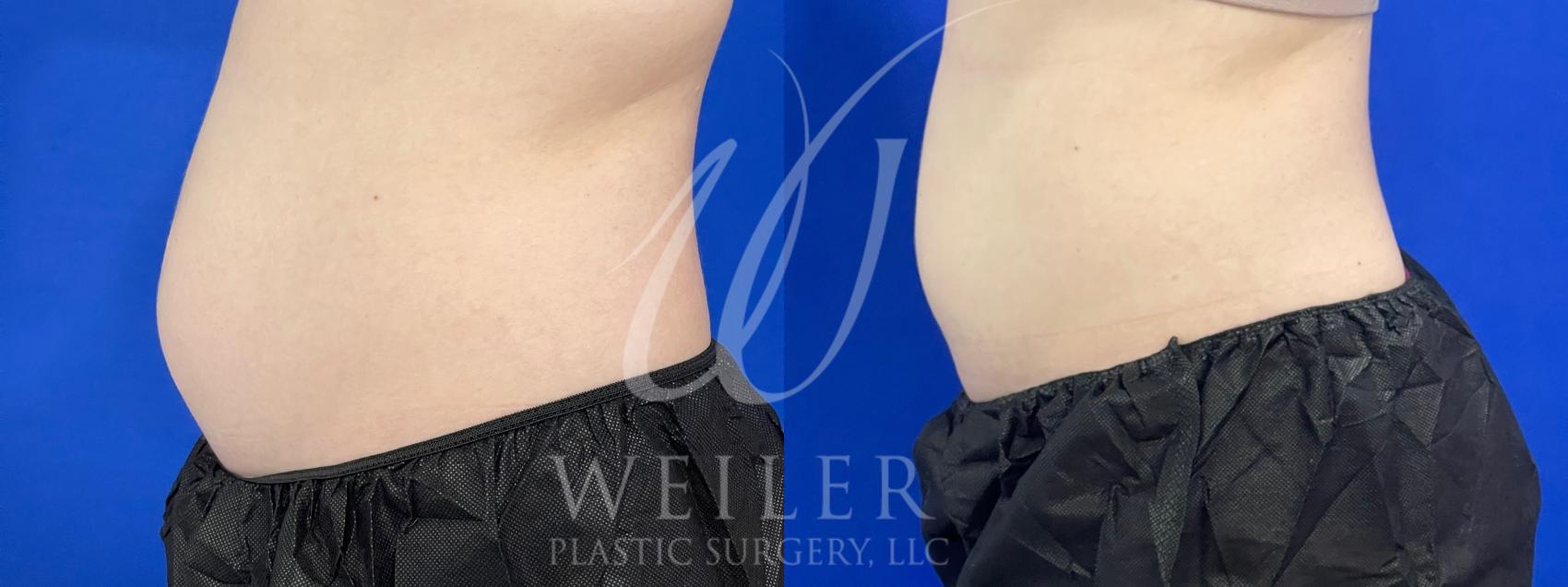 Before & After CoolSculpting Case 976 Left Side View in Baton Rouge, New Orleans, & Lafayette, Louisiana