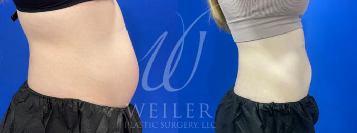 Before & After CoolSculpting Case 976 Right Side View in Baton Rouge, New Orleans, & Lafayette, Louisiana