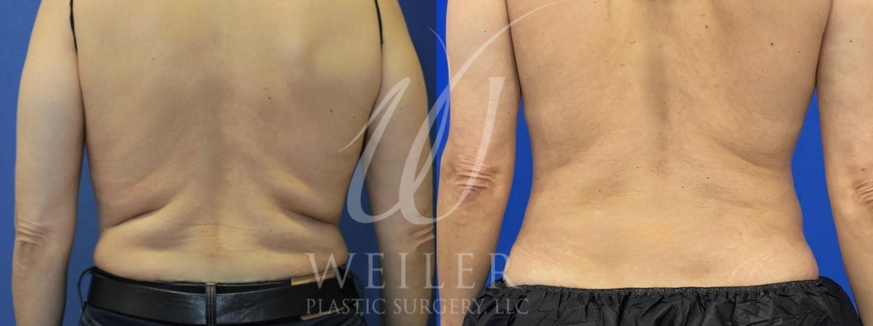 Before & After CoolSculpting Case 977 Back View in Baton Rouge, New Orleans, & Lafayette, Louisiana