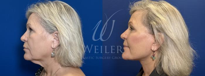 Before & After Deep Plane Facelift Case 1820 Left Side View in Baton Rouge, New Orleans, & Lafayette, Louisiana