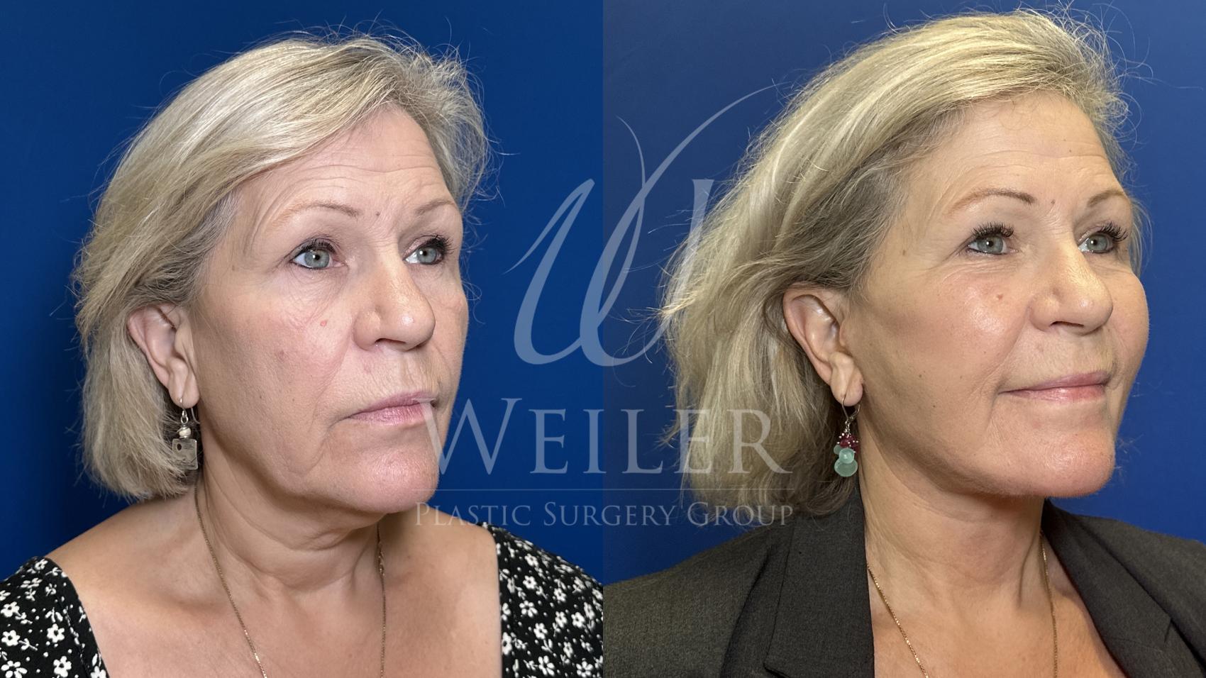 Before & After Deep Plane Facelift Case 1820 Right Oblique View in Baton Rouge, New Orleans, & Lafayette, Louisiana