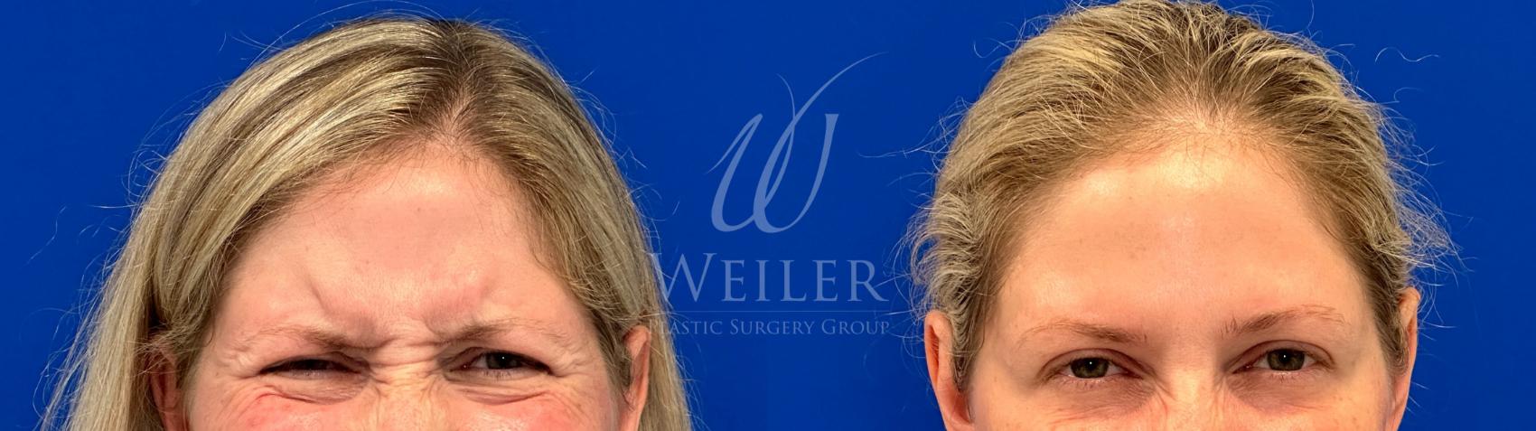 Before & After Dysport® Case 1319 Front View in Baton Rouge, New Orleans, & Lafayette, Louisiana