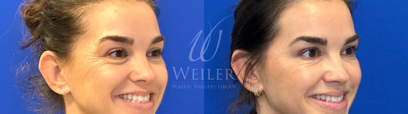 Before & After Dysport® Case 1776 Right Oblique View in Baton Rouge, New Orleans, & Lafayette, Louisiana
