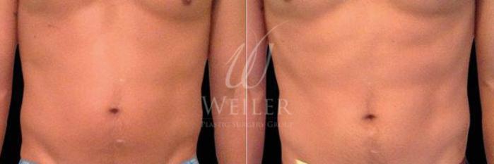 Before & After EMSculpt Case 220 View #1 View in Baton Rouge, Louisiana