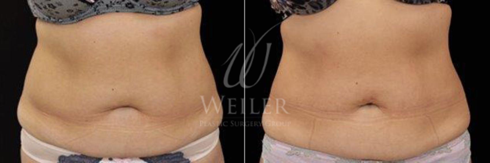 Before & After EMSculpt Case 223 View #1 View in Baton Rouge, Louisiana