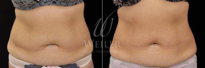 Before & After EMSculpt Case 223 View #1 View in Baton Rouge, Louisiana