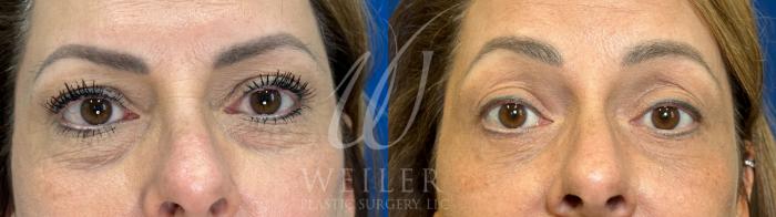 Before & After Eyelid Surgery Case 1045 Front View in Baton Rouge, New Orleans, & Lafayette, Louisiana