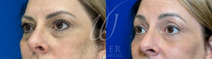 Before & After Eyelid Surgery Case 1045 Left Oblique View in Baton Rouge, New Orleans, & Lafayette, Louisiana