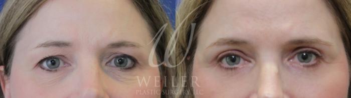Before & After Eyelid Surgery Case 1064 Front View in Baton Rouge, New Orleans, & Lafayette, Louisiana