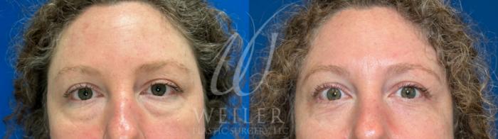 Before & After Eyelid Surgery Case 1082 Front View in Baton Rouge, New Orleans, & Lafayette, Louisiana