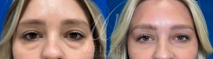 Before & After Eyelid Surgery Case 1083 Front View in Baton Rouge, Louisiana