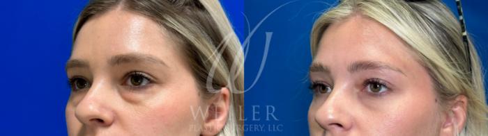 Before & After Eyelid Surgery Case 1083 Left Oblique View in Baton Rouge, New Orleans, & Lafayette, Louisiana