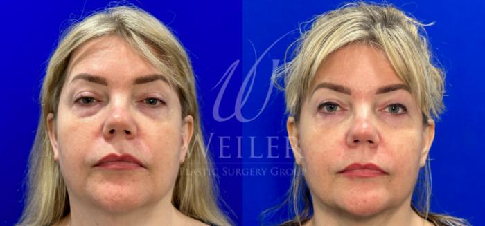 Before & After Eyelid Surgery Case 1127 Front View in Baton Rouge, New Orleans, & Lafayette, Louisiana