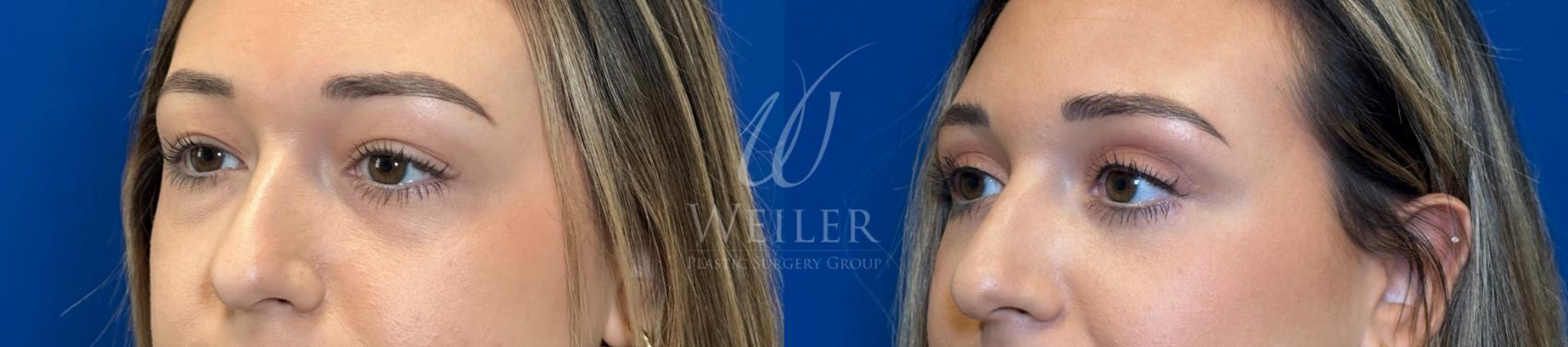 Before & After Eyelid Surgery Case 1253 Left Oblique View in Baton Rouge, New Orleans, & Lafayette, Louisiana