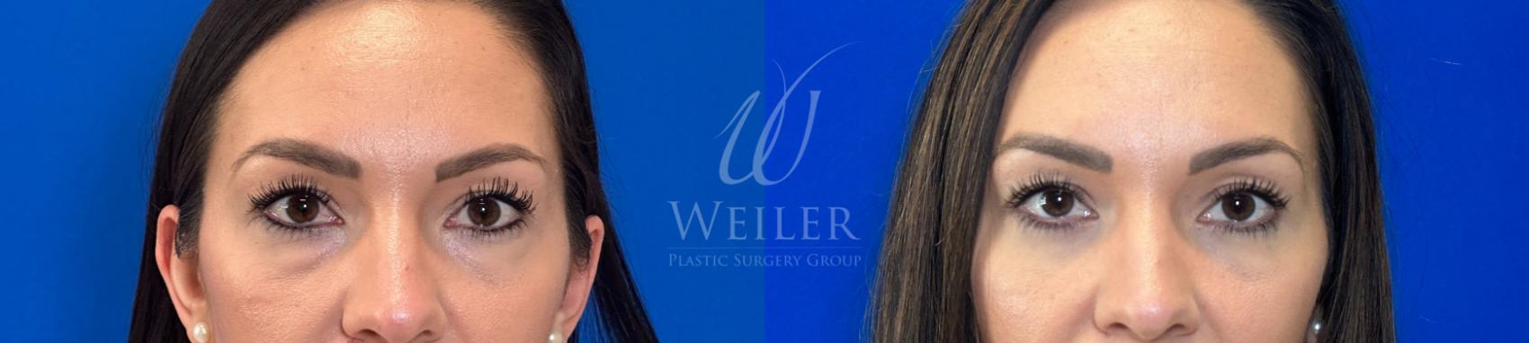 Before & After Eyelid Surgery Case 1254 Front View in Baton Rouge, New Orleans, & Lafayette, Louisiana