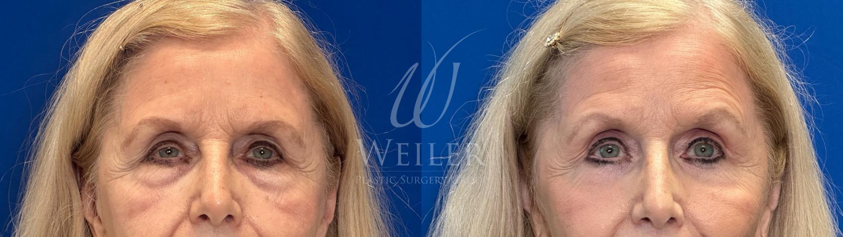 Before & After Eyelid Surgery Case 1303 Front View in Baton Rouge, New Orleans, & Lafayette, Louisiana