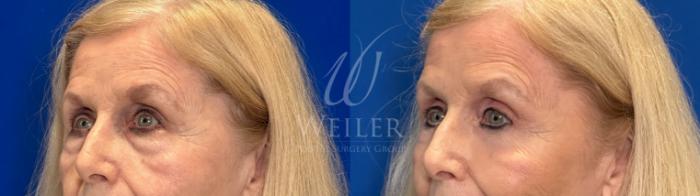 Before & After Eyelid Surgery Case 1303 Right Side View in Baton Rouge, New Orleans, & Lafayette, Louisiana