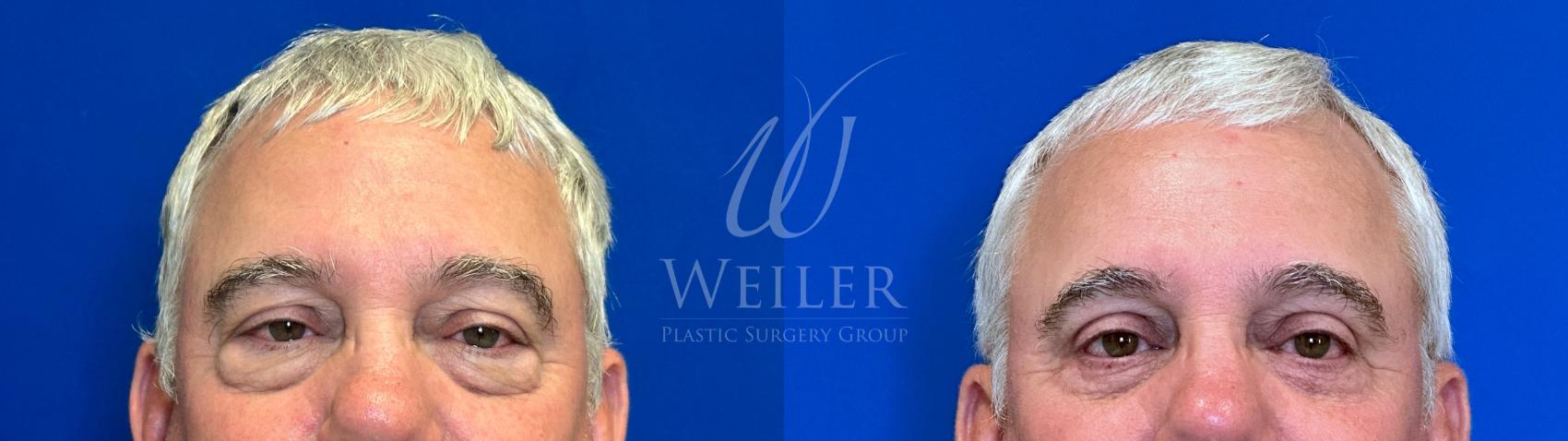 Before & After Eyelid Surgery Case 1353 Front View in Baton Rouge, New Orleans, & Lafayette, Louisiana