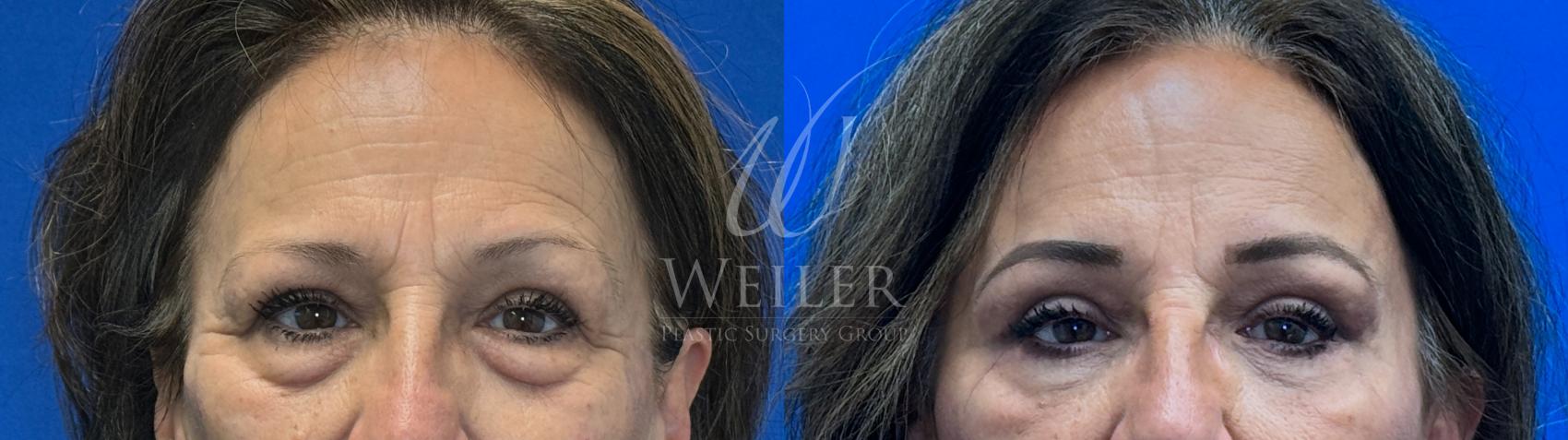 Before & After Eyelid Surgery Case 1363 Front View in Baton Rouge, New Orleans, & Lafayette, Louisiana