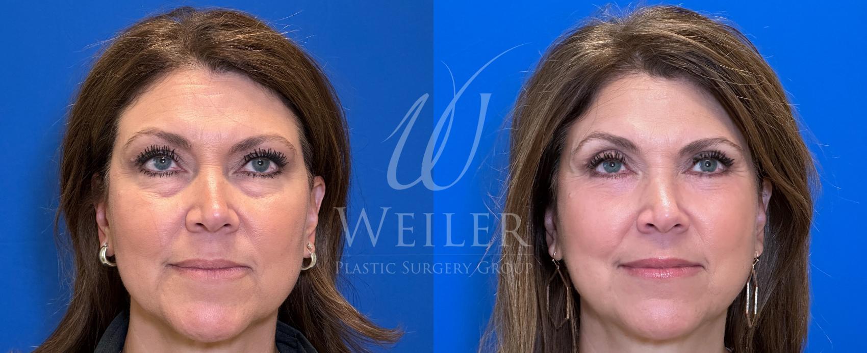 Before & After Eyelid Surgery Case 1408 Front View in Baton Rouge, New Orleans, & Lafayette, Louisiana