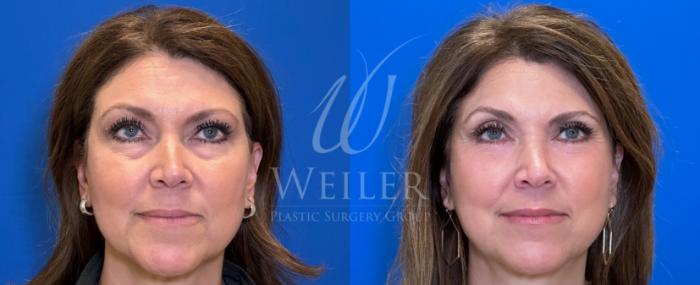 Before & After Eyelid Surgery Case 1408 Front View in Baton Rouge, New Orleans, & Lafayette, Louisiana