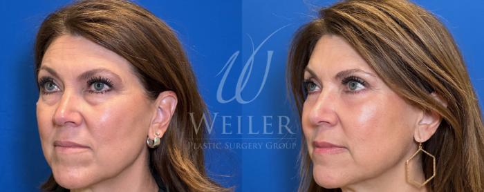 Before & After Eyelid Surgery Case 1408 Left Oblique View in Baton Rouge, New Orleans, & Lafayette, Louisiana