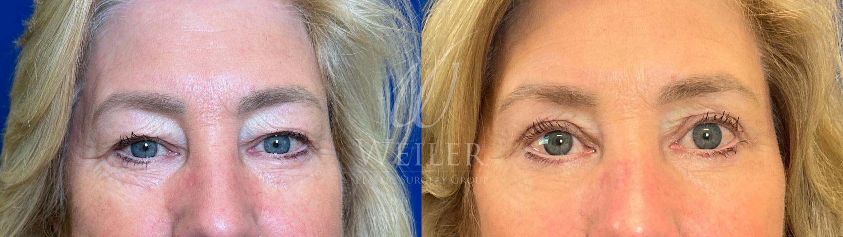 Before & After Eyelid Surgery Case 1445 Front View in Baton Rouge, New Orleans, & Lafayette, Louisiana