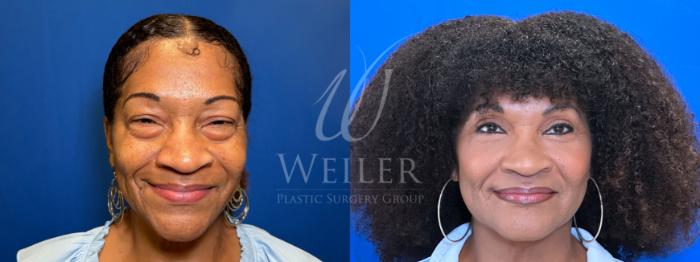 Before & After Eyelid Surgery Case 1446 Front View in Baton Rouge, New Orleans, & Lafayette, Louisiana