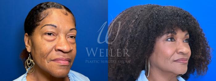 Before & After Eyelid Surgery Case 1446 Right Side View in Baton Rouge, New Orleans, & Lafayette, Louisiana