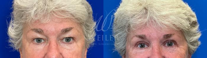 Before & After Eyelid Surgery Case 1447 Front View in Baton Rouge, New Orleans, & Lafayette, Louisiana