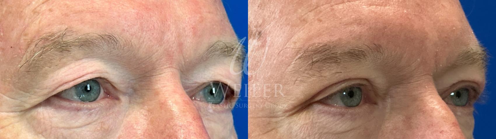 Before & After Eyelid Surgery Case 1576 Right Oblique View in Baton Rouge, New Orleans, & Lafayette, Louisiana