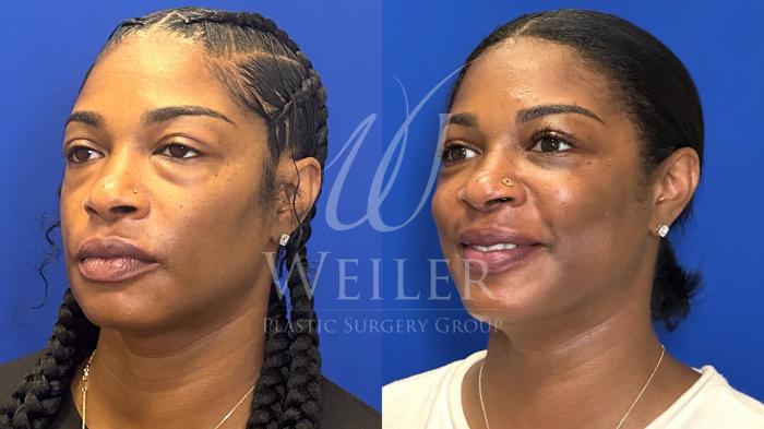 Before & After Eyelid Surgery Case 1653 Left Oblique View in Baton Rouge, New Orleans, & Lafayette, Louisiana