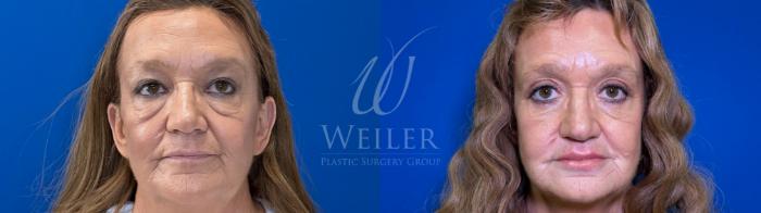 Before & After Eyelid Surgery Case 1654 Front View in Baton Rouge, New Orleans, & Lafayette, Louisiana