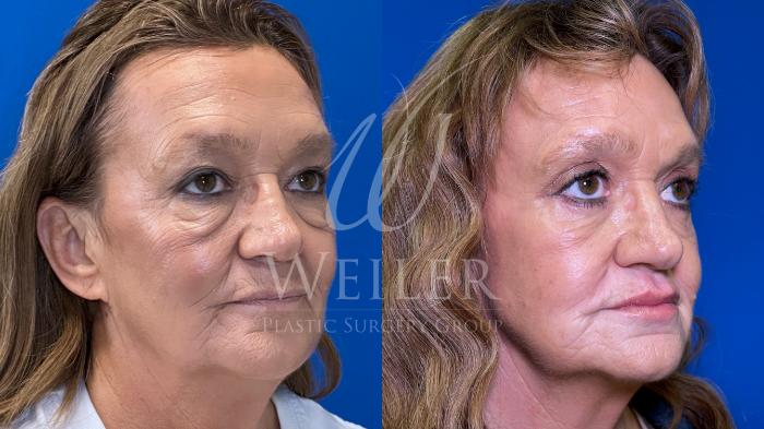 Before & After Eyelid Surgery Case 1654 Right Side View in Baton Rouge, New Orleans, & Lafayette, Louisiana