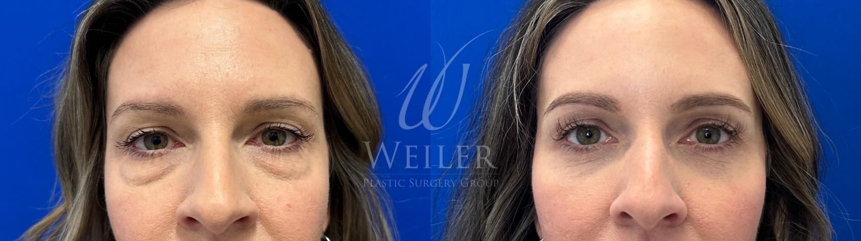 Before & After Eyelid Surgery Case 1671 Front View in Baton Rouge, New Orleans, & Lafayette, Louisiana