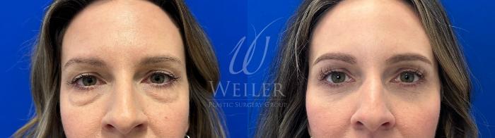 Before & After Eyelid Surgery Case 1671 Front View in Baton Rouge, New Orleans, & Lafayette, Louisiana