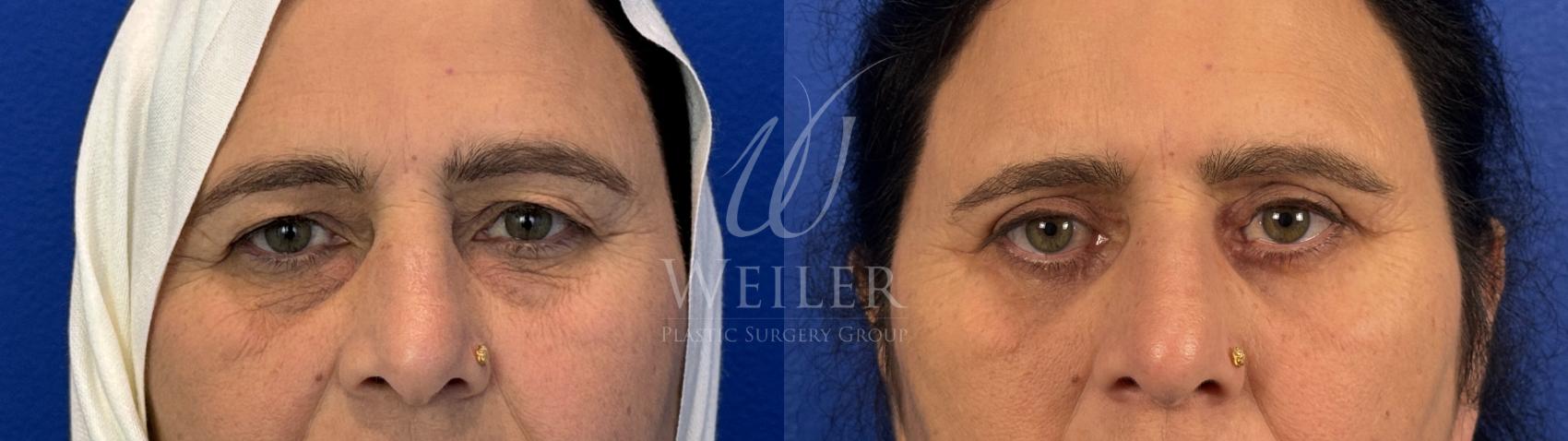 Before & After Eyelid Surgery Case 1680 Front View in Baton Rouge, New Orleans, & Lafayette, Louisiana