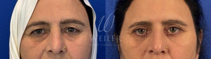 Before & After Eyelid Surgery Case 1680 Front View in Baton Rouge, New Orleans, & Lafayette, Louisiana
