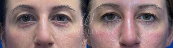 Before & After Eyelid Surgery Case 1721 Front View in Baton Rouge, New Orleans, & Lafayette, Louisiana