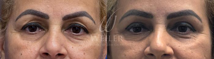 Before & After Eyelid Surgery Case 1747 Front View in Baton Rouge, New Orleans, & Lafayette, Louisiana