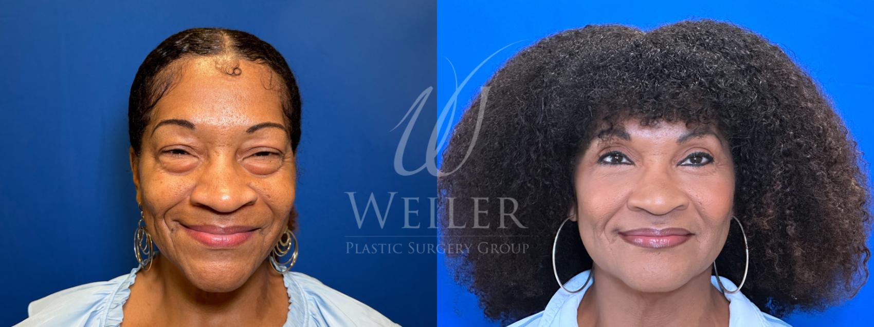 Before & After Eyelid Surgery Case 1777 Front View in Baton Rouge, New Orleans, & Lafayette, Louisiana