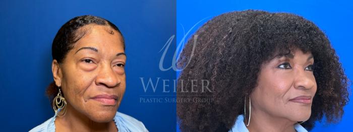 Before & After Eyelid Surgery Case 1777 Right Side View in Baton Rouge, New Orleans, & Lafayette, Louisiana