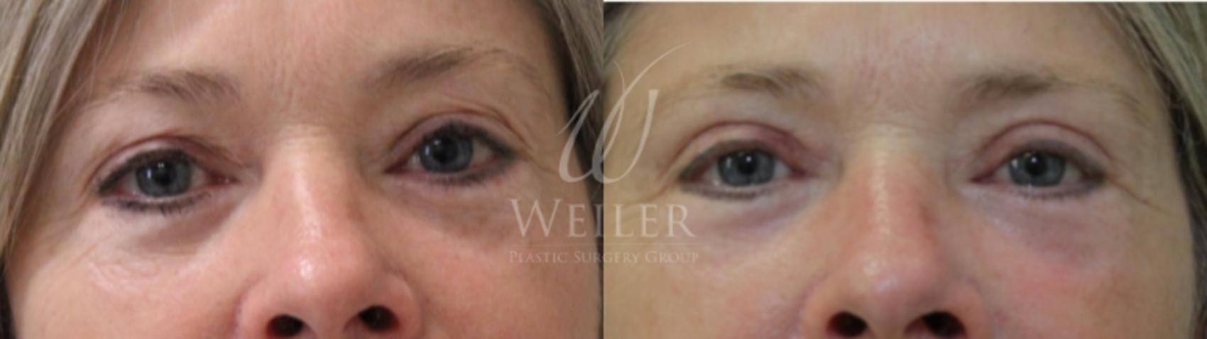 Before & After Eyelid Surgery Case 229 View #1 View in Baton Rouge, Louisiana