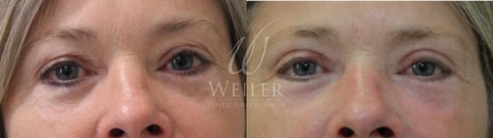 Before & After Eyelid Surgery Case 229 View #1 View in Baton Rouge, New Orleans, & Lafayette, Louisiana