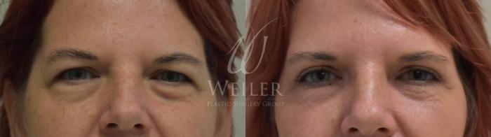 Before & After Eyelid Surgery Case 285 View #1 View in Baton Rouge, New Orleans, & Lafayette, Louisiana