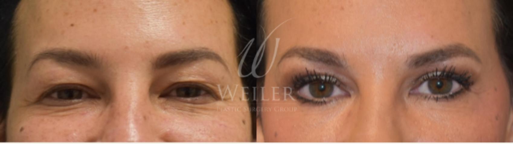 Before & After Eyelid Surgery Case 297 View #1 View in Baton Rouge, Louisiana