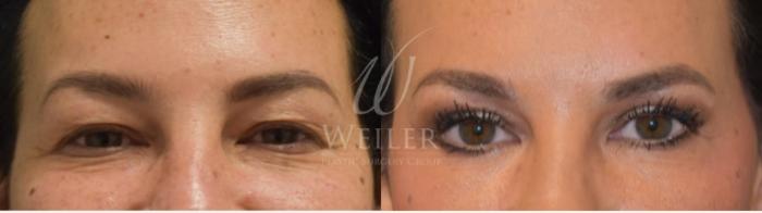 Before & After Eyelid Surgery Case 297 View #1 View in Baton Rouge, New Orleans, & Lafayette, Louisiana