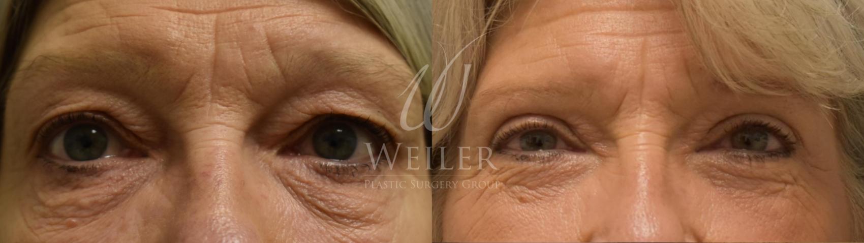 Before & After Eyelid Surgery Case 299 View #1 View in Baton Rouge, New Orleans, & Lafayette, Louisiana