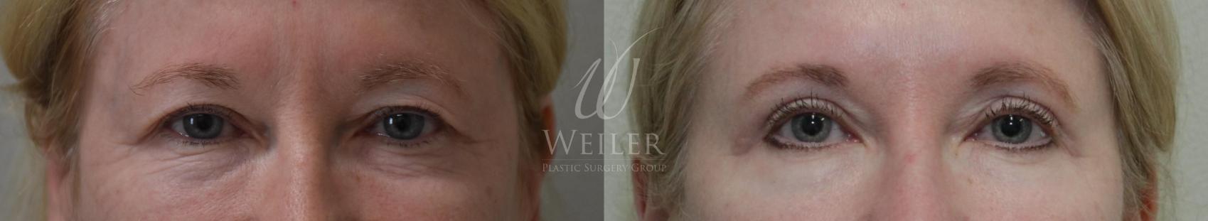 Before & After Eyelid Surgery Case 315 View #1 View in Baton Rouge, Louisiana